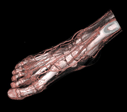 Cellulitis Dorsum of Foot Seen on CTA - CTisus CT Scan