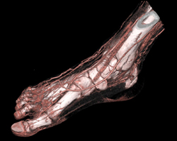 CTA Foot - CTisus CT Scan