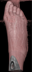 Ulcer on Foot - CTisus CT Scan