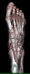 Cellulitis at Ulcer Site - CTisus CT Scan