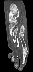 Gout - CTisus CT Scan