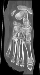 Gout - CTisus CT Scan