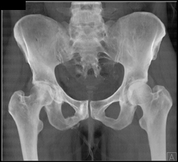 Sacral and Pelvic Fractures - CTisus CT Scan