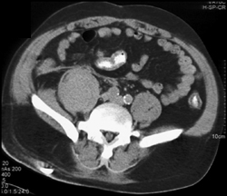 Right Sacroiliitis With Swollen Psoas - CTisus CT Scan