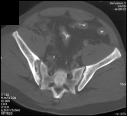 Erosions Right Sacroiliac Joints in Patient With Crohn's Disease - CTisus CT Scan