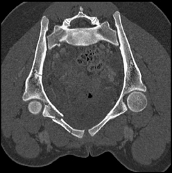 Sacral and Symphysis Fractures - CTisus CT Scan