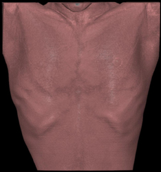 Pectus Deformity - CTisus CT Scan