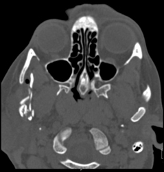 Mandibular Fracture - CTisus CT Scan