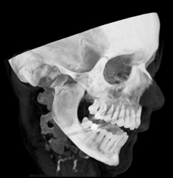 Mandibular Fracture - CTisus CT Scan