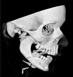 Mandibular Fracture - CTisus CT Scan