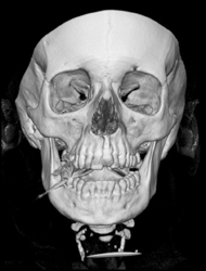 Mandibular Fracture - CTisus CT Scan