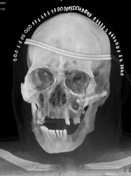 Orbital Fractures With Repair - CTisus CT Scan