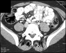 One Too Many Attempt at A Lumbar Juncture. Air in Paraspinal Process - CTisus CT Scan