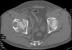 Acetabular Fracture With Right SI Joint Diastasis - CTisus CT Scan