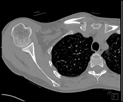 Clavicular Fracture - CTisus CT Scan