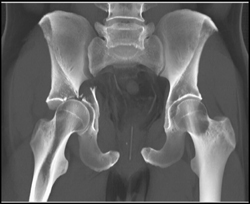 right acetabular fracture