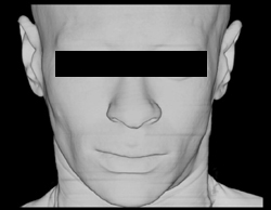 Mandibular Fracture - CTisus CT Scan