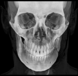 Mandibular Fracture - CTisus CT Scan