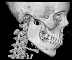 Mandibular Fracture - CTisus CT Scan