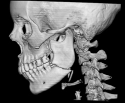 Mandibular Fracture - CTisus CT Scan