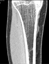 Bone Bruise - CTisus CT Scan