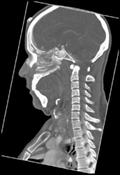 Normal C-spine - CTisus CT Scan