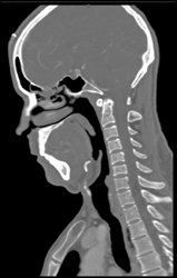 Normal Circle of Willis - CTisus CT Scan