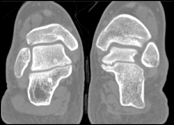 Tarsal Coalition - CTisus CT Scan