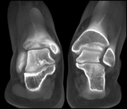 Tarsal Coalition - CTisus CT Scan