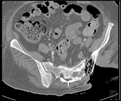 Large Decubitis With Osteomyelitis - CTisus CT Scan