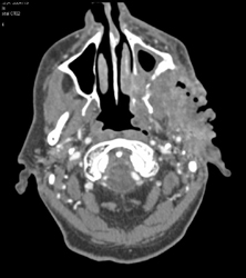 Ulcerating Squamous Cell Carcinoma - CTisus CT Scan