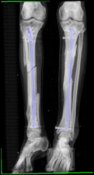 Non Union on Right - CTisus CT Scan