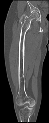 Osteogenesis Imperfecta - CTisus CT Scan