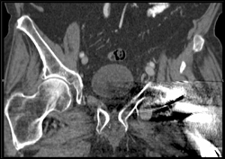 Small Pseudoaneurysm Lt Groin - CTisus CT Scan