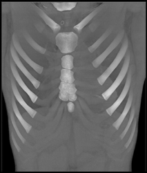 Pectus Deformity - CTisus CT Scan