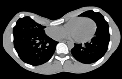 Pectus Deformity - CTisus CT Scan