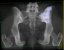 Post Fusion Left SI Joint - CTisus CT Scan