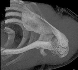 Coracoid Fracture - CTisus CT Scan