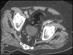 Necrotizing Fasciitis - CTisus CT Scan