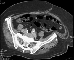 Necrotizing Fasciitis - CTisus CT Scan