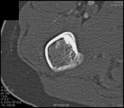 Osteoid Osteoma - CTisus CT Scan