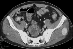 Metastatic Renal Cell Carcinoma to Muscle - CTisus CT Scan