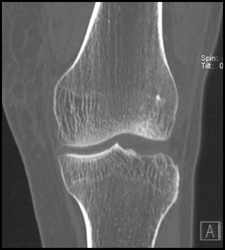 Small Intra-articular Fragment of Bone - CTisus CT Scan