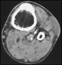 Neurofibromatosis - CTisus CT Scan