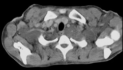 Neurofibromatosis - CTisus CT Scan