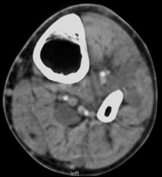 Neurofibromatosis - CTisus CT Scan