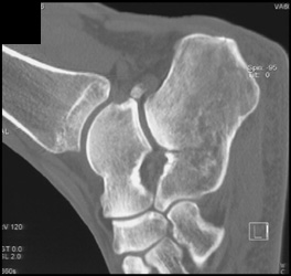 Calcaneal Fracture - CTisus CT Scan