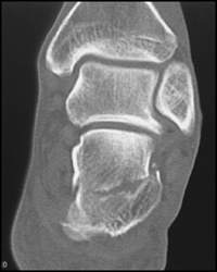 Calcaneal Fracture - CTisus CT Scan