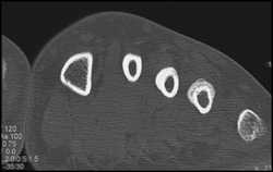 Periosteal Rxn Due to Stress Fracture - CTisus CT Scan