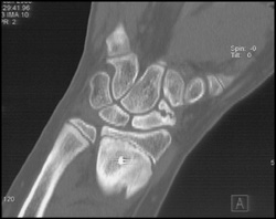 Nonunion of Fracture - CTisus CT Scan